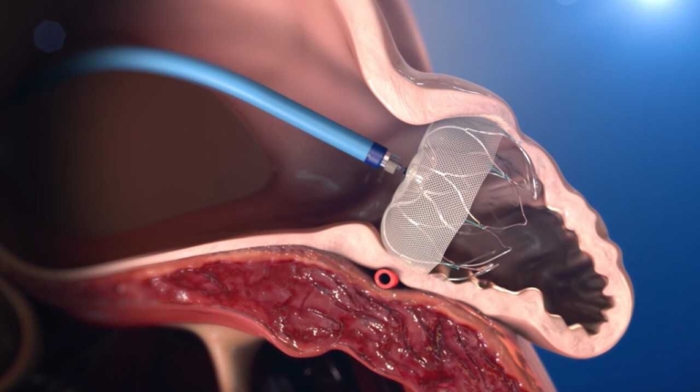 St. Francis Medical Center first in Mercer County to offer Watchman implant