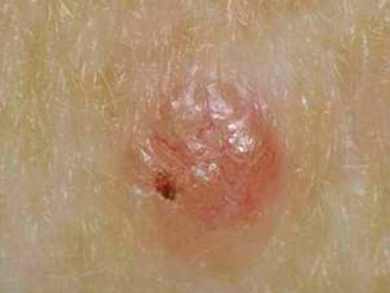 Aura Dermatology: Tips for Preventing Skin Cancer